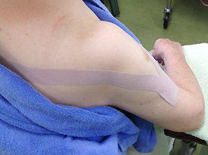 アクションテックスによるテーピング固定