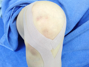 テーピング固定（ひざ）