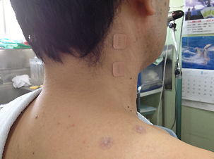 チタンテープ・皮内鍼